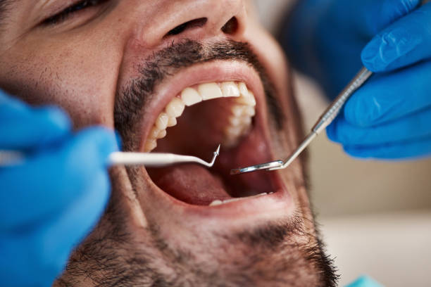 Best Emergency Dentist for Lost Fillings or Crowns in Hancock, MD